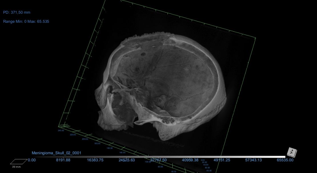 The research team examined the skulls from the Duckworth Laboratory collection at the University of Cambridge using microscopic analysis and CT scanning.