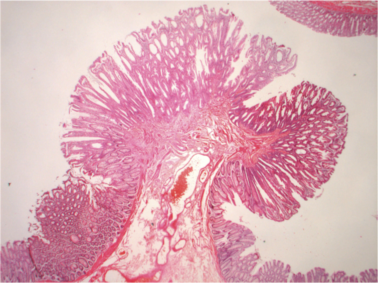 Microscopic image of a colon polyp, which looks like a tree with a round top of pink spongy tissue