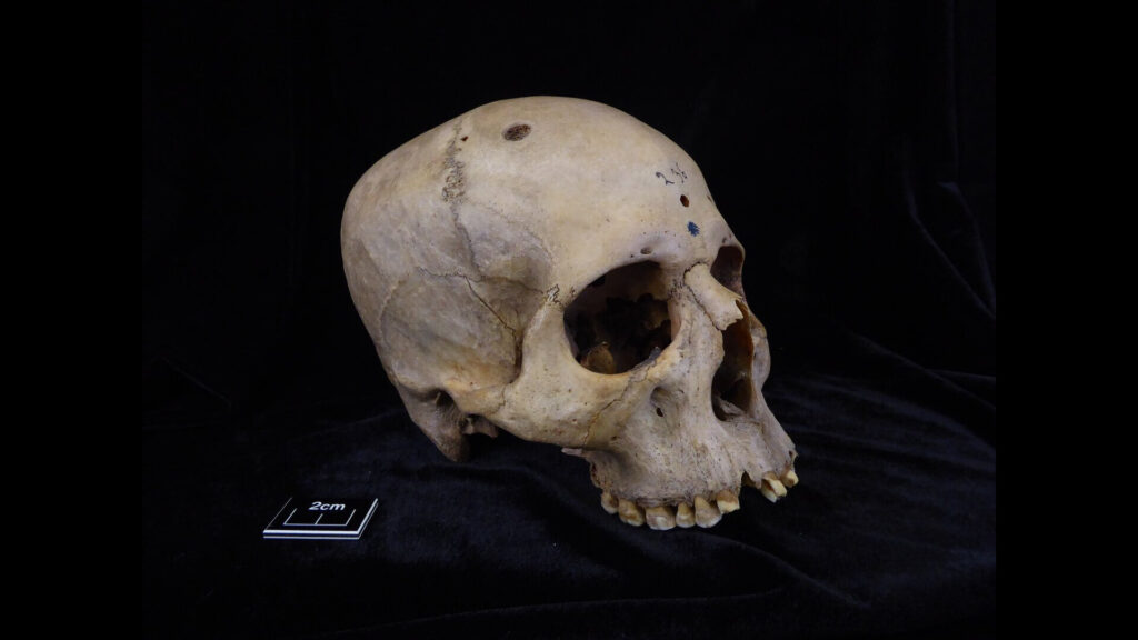 “Extraordinary” 4,000-year-old Egyptian skull may show signs of cancer treatment attempts