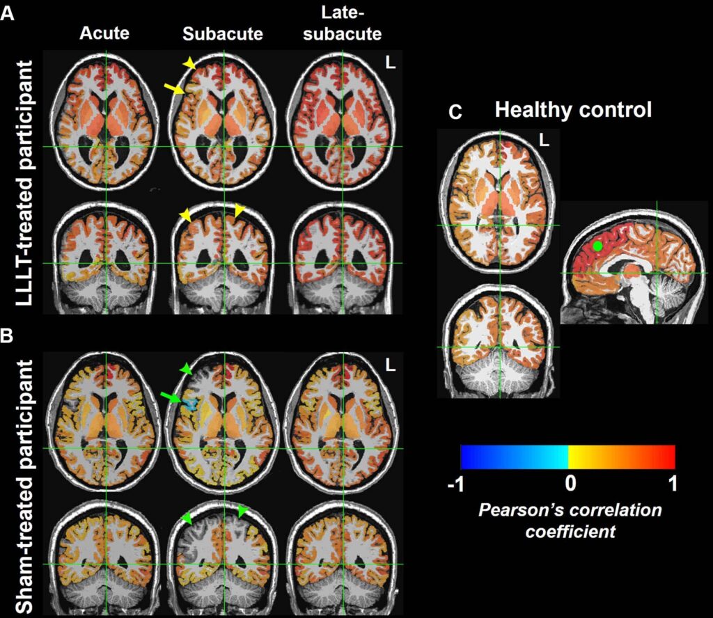 Light therapy increases brain connectivity after injury, study finds