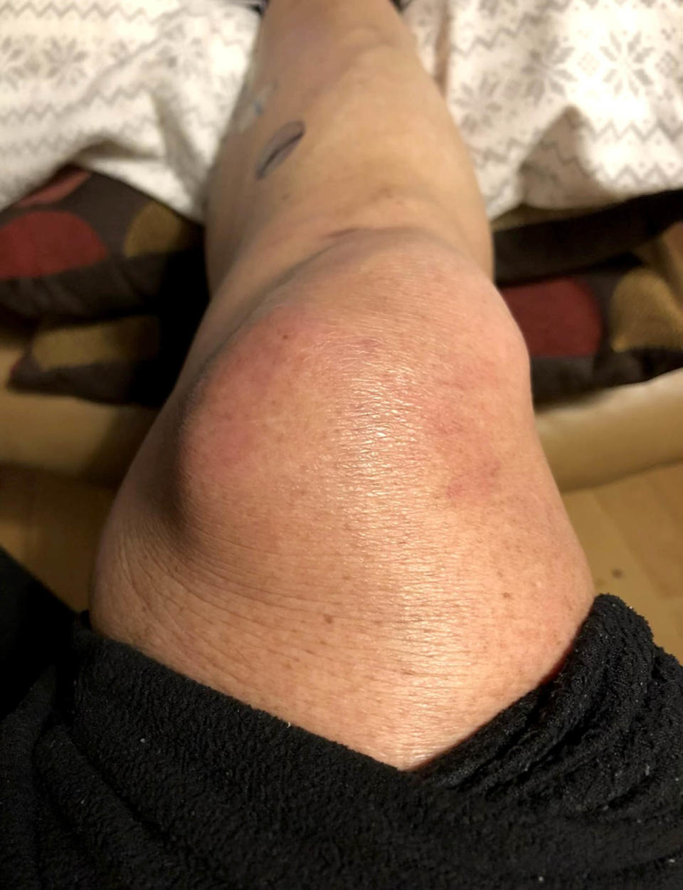 Mary Witkop knee cancer (Courtesy Mary Witkop)