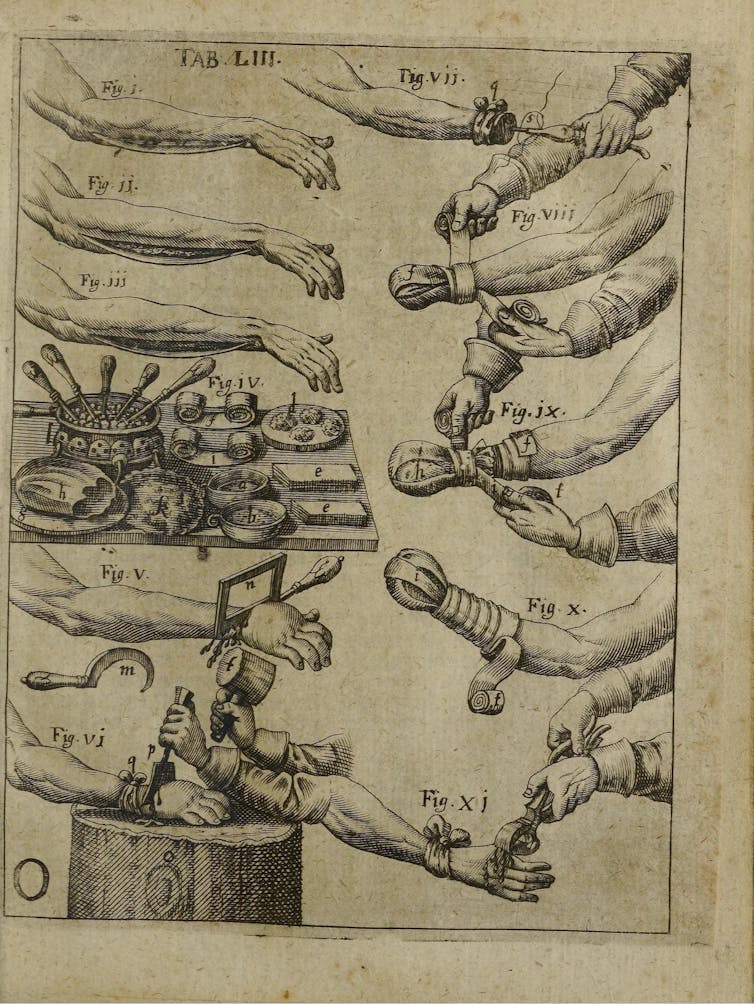 Sketch on parchment illustrating several types of hand amputations, notably with a mallet and a chisel