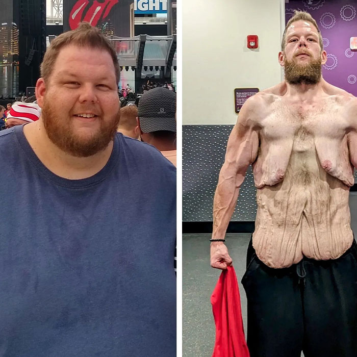 Man Raises $76,000 to Surgically Remove Excess Skin After Huge Weight Loss Transformation