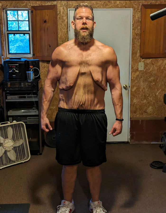 Man Raises $76,000 to Surgically Remove Excess Skin After Huge Weight Loss Transformation