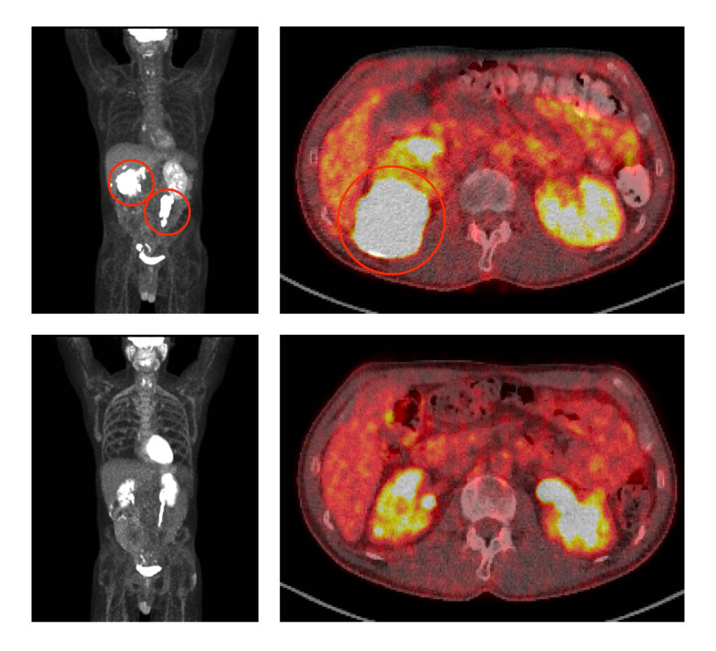 Combined targeted therapy produces lasting remissions in people with aggressive, resistant B-cell lymphoma