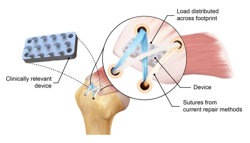 New device inspired by python teeth doubles the strength of rotator cuff repairs