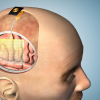 This illustration shows how the thin film of sensors could be applied to the brain during surgery.