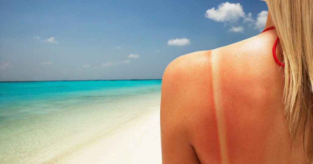 Think you can't get skin cancer from just one sunburn? Think again.