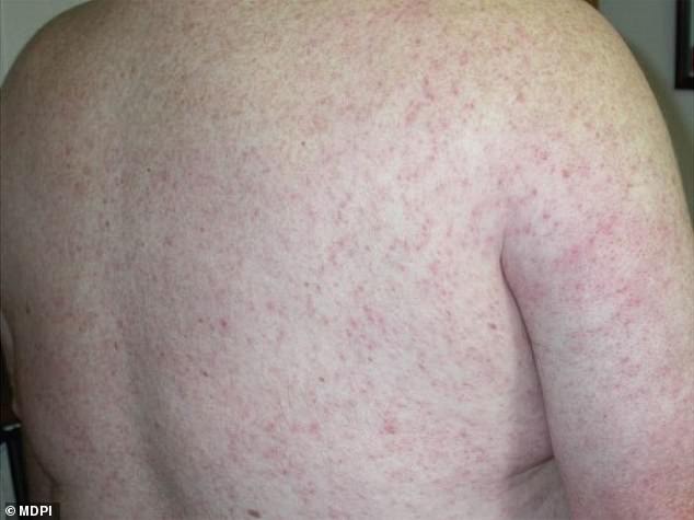 About one in five patients develop West Nile symptoms, which may include a rash, pictured above.  Less than one percent of them end up suffering from a severe form of the disease.