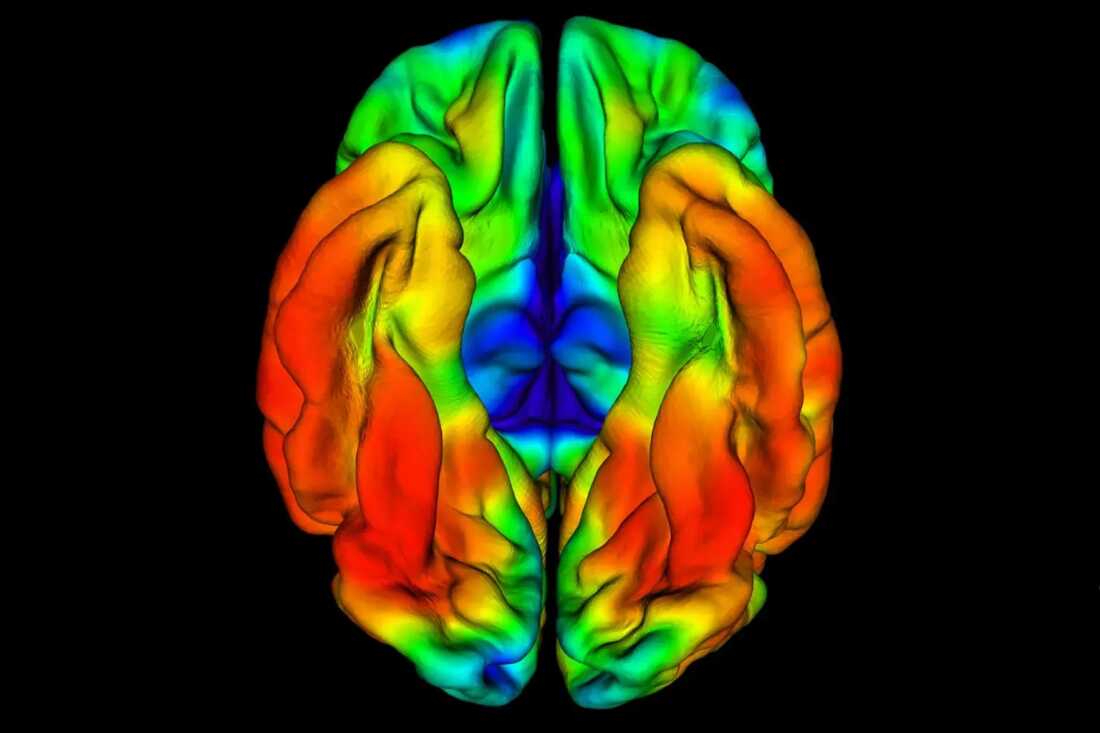 This PET image shows the brain of a Colombian man whose memory and thinking remained intact in his late 60s, even though he carried a rare genetic variant that almost always causes Alzheimer's disease in a 40-year-old.