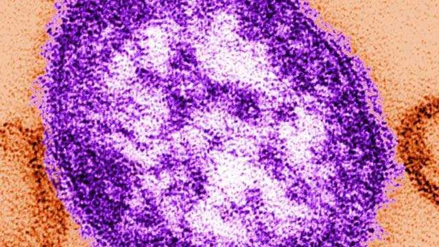 First measles case confirmed since 2020 in Massachusetts