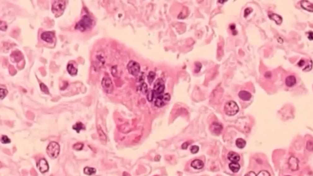 Measles case linked to international traveler confirmed in New Hampshire resident