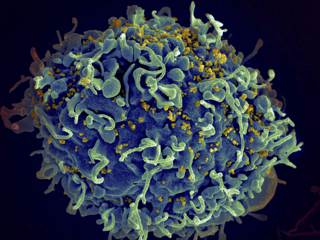 Seventh HIV patient likely cured after stem cell transplant for leukemia, scientists say