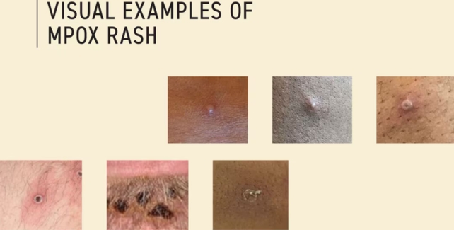 Photos of Mpox rash