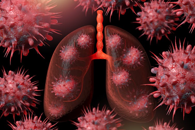 Computer-generated image of coronavirus inside the lungs surrounded by multiple copies of the virus.