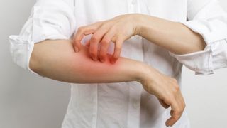 A person in a white shirt scratches his itchy red forearm because he has a scabies infection.